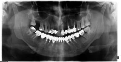N crose pulpaire bridge 3 ans 16122013 wo4jfh - Eugenol