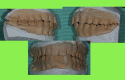 Occlusion 1 ed4c3l - Eugenol