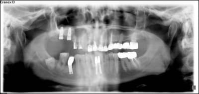 Opt implant goigyd - Eugenol