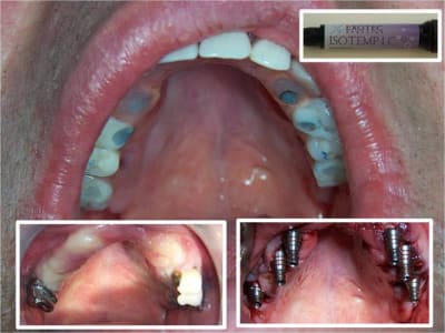 Obturation pilier d implant ajv8xw - Eugenol