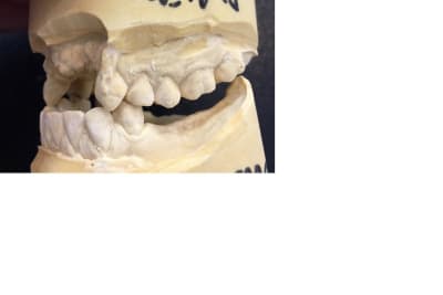 Occlusion gauche uc5fdu - Eugenol