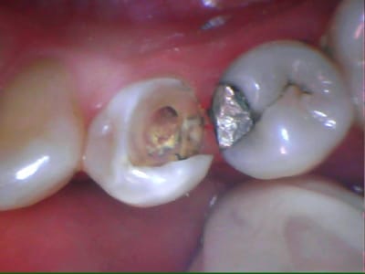 Onlay 34 lqwhxp - Eugenol