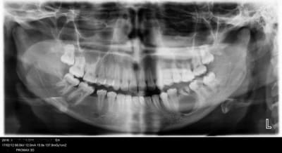 Pano kyste z4tlaz - Eugenol