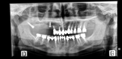 Pano mangers robert 2011 21 juin post op pj1f13 - Eugenol