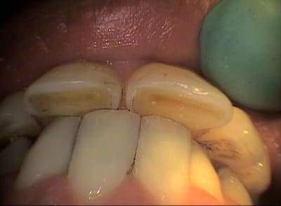 Pim gocmuh - Eugenol