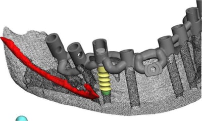 Positdental 5 ugx4r2 - Eugenol