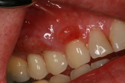 Post op 14j 001 akcbqu - Eugenol