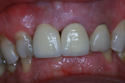 Post op implant dent 11  couronne 21 004 zq2gbm - Eugenol