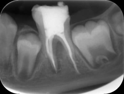 Post op 1 qinen3 - Eugenol