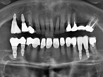 Pano lésion 32 vw9qco - Eugenol