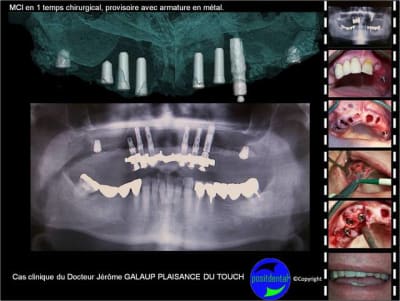 Planification implantaire assist e par ordinateur positdental u7nd1n - Eugenol