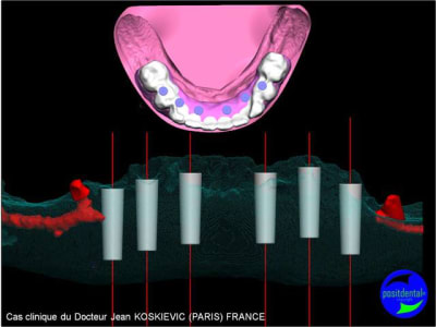 Planification implantaire assist e par ordinateur  guide radio opaque 2 m1yh2e - Eugenol