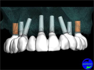 Positdental 005 jjw6lf - Eugenol