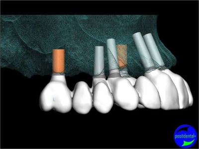 Positdental 006 wfjfl2 - Eugenol