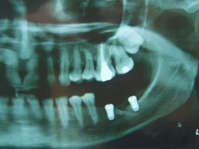 Positdental 022 u3cow3 - Eugenol