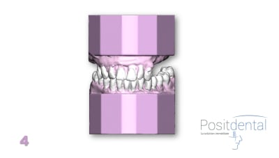 Positdental mci mise en charge immédiate 004 vecrjn - Eugenol