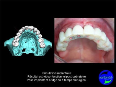 Protocole mci post extractionnelle positdental 007 l2fraj - Eugenol