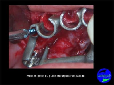 Protocole mci post extractionnelle positdental 009 zkkl8e - Eugenol