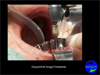 Protocole mci post extractionnelle positdental 013 o2je67 - Eugenol