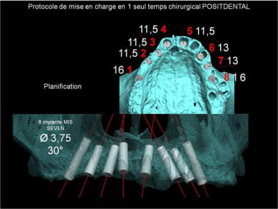 Protocole de mise en charge imm diate positdental 005 mwdgkj - Eugenol