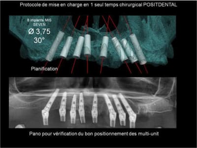 Protocole de mise en charge imm diate positdental 006 hoc1rf - Eugenol