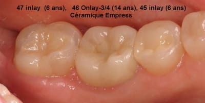 Q4 post op iffgsh - Eugenol