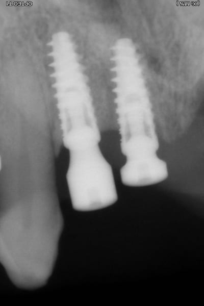 Rvg implants p3ijc8 - Eugenol