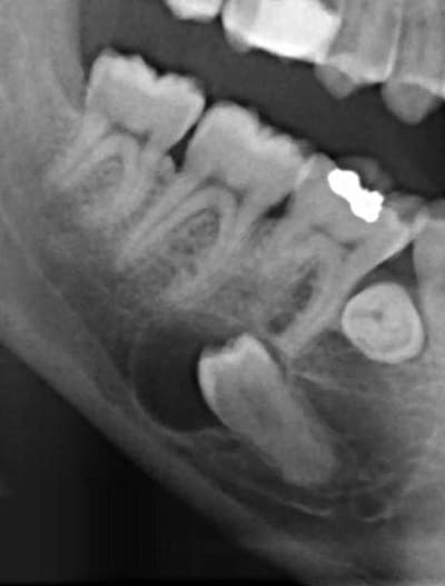 Radiographie gqdzul - Eugenol