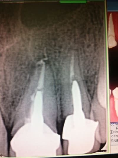 Retro incisive mtxbmm - Eugenol