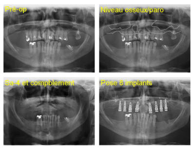 Sa 4 et 8 implants 2  g21beh - Eugenol