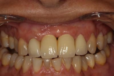 Sourire iqu4bl - Eugenol