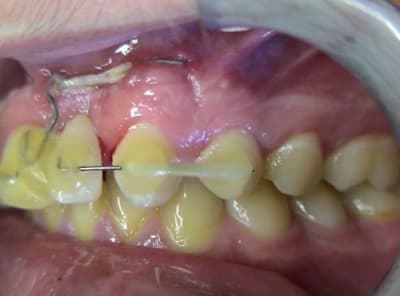 Trauma 3 q3dmlp - Eugenol