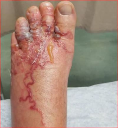 Vers pieds ckjcj6 - Eugenol