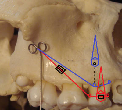 Vis d ancrage idtjht - Eugenol