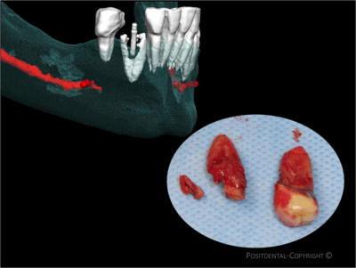 Www.positdental - Eugenol