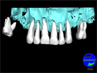 Wax up 3d positdental 12 slthxf - Eugenol