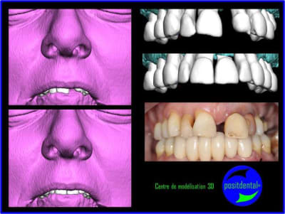Wax up 3d positdental vu0lys - Eugenol