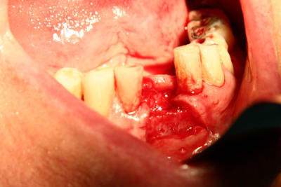   implant xiljmv - Eugenol