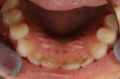  rosion 3 1 embkt4 - Eugenol