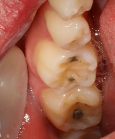  rosion 4 1 pt8s9r - Eugenol
