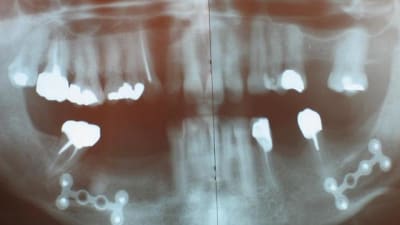 Antre cas thtgws - Eugenol