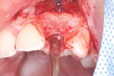 Aspect osseux1n fivude - Eugenol