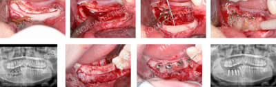 Augmentation crestale verticale ezqjoa - Eugenol