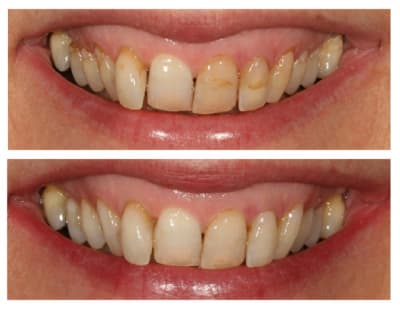 Avant apres sujif0 - Eugenol