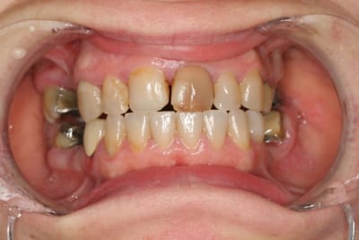 Avant qmawau - Eugenol