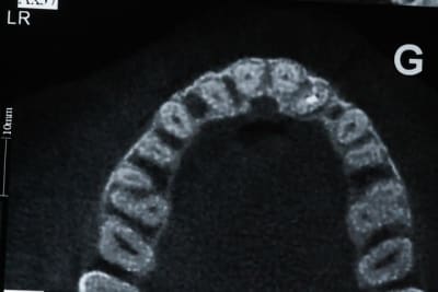 Axial cervical ppk0fk - Eugenol