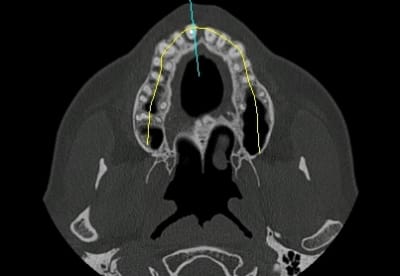 Axial t8dzmd - Eugenol