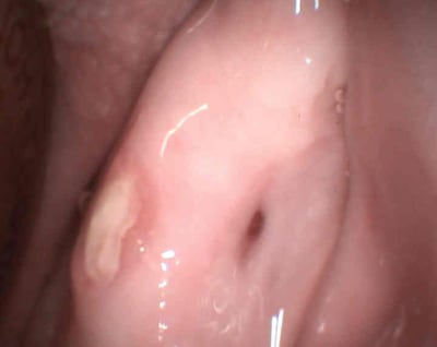 Biphosphnates 2 ybdcyr - Eugenol