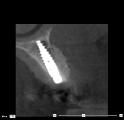 Bourdon scan apres xgacpr - Eugenol