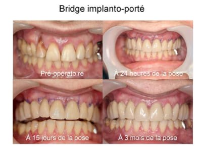 Bridge implanto port  umxwqi - Eugenol